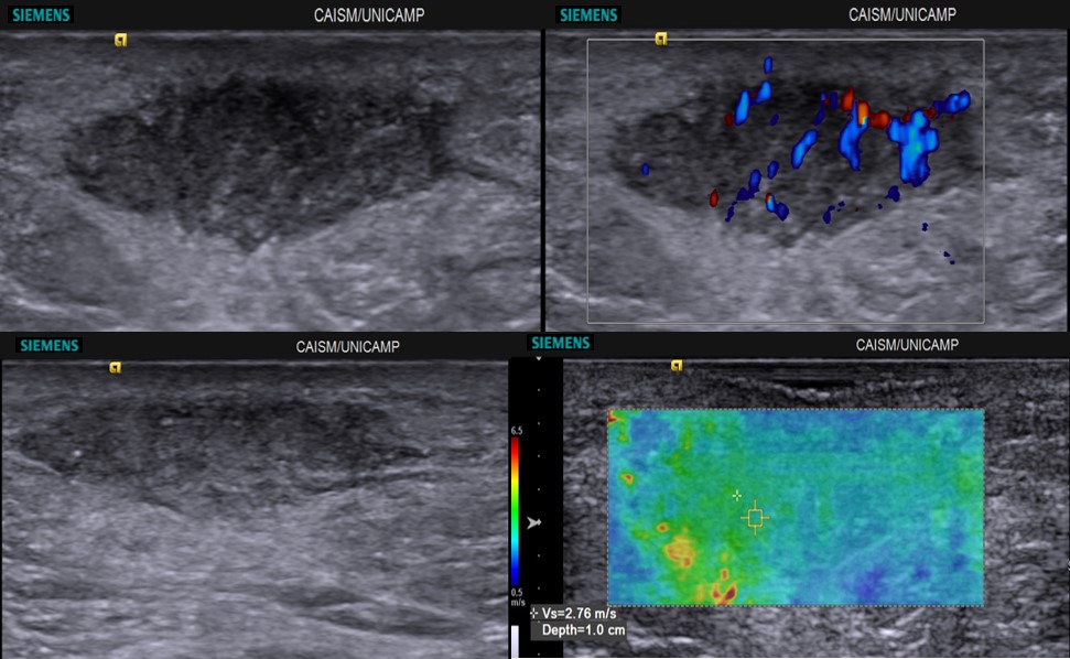 Ginecomastia glandular - ultrassonografia nos modos b, doppler e elastografia