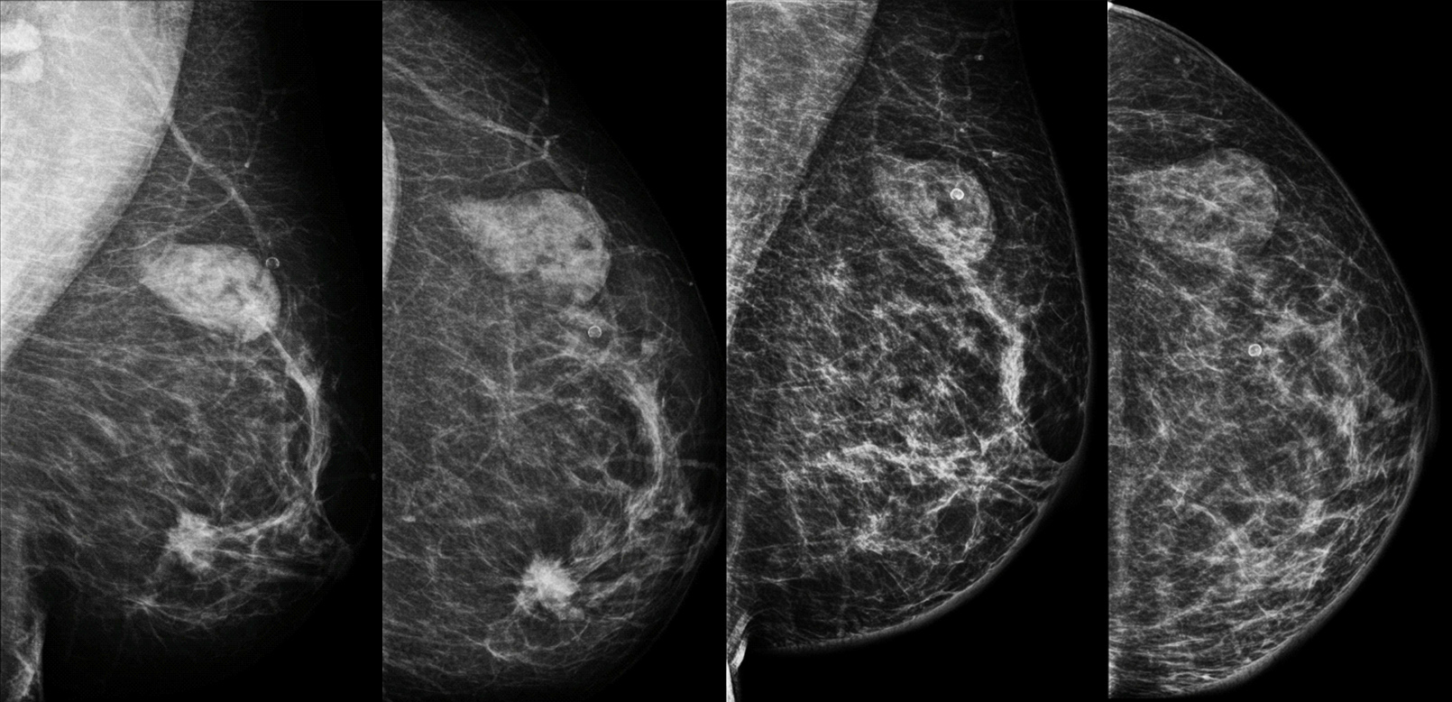 CDI e hamartoma sincrônicos