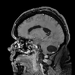 Hemangioblastoma Intracraniano