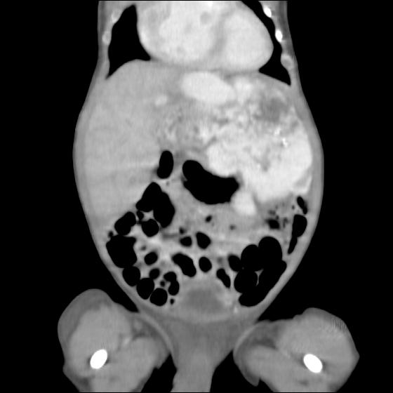Hemangioma Hepático Gigante