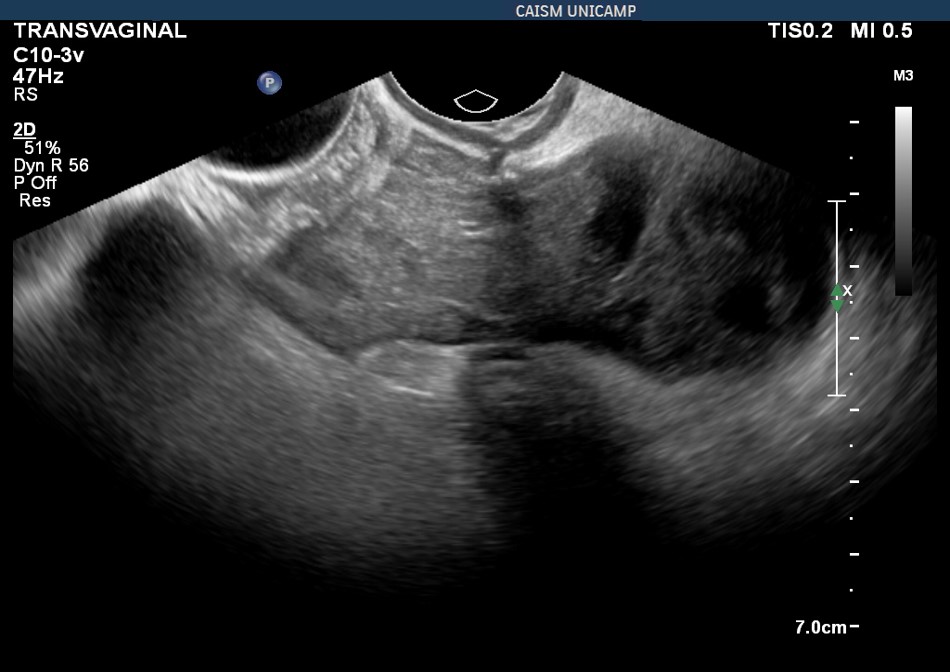 Hematoma em cúpula vaginal em pós operatório de histerectomia