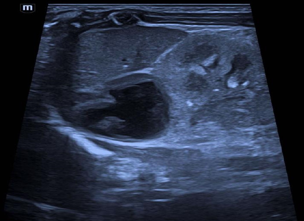 Hemorragia adrenal em recém nascido