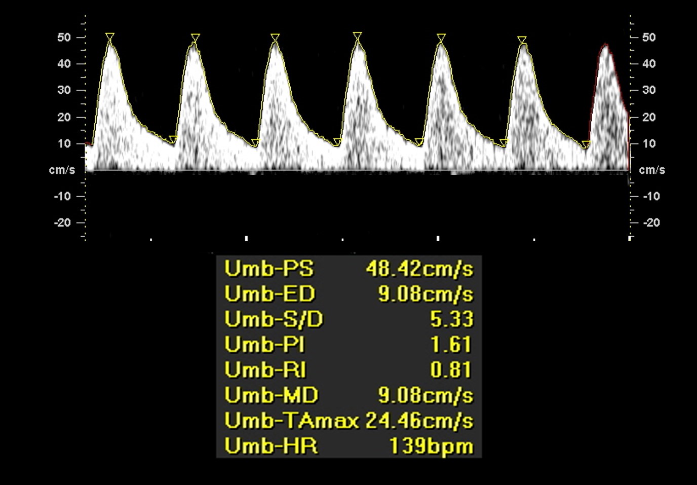 interpretacao-do-doppler-obstetrico-na-avaliacao-da-vitalidade-fetal-image-2