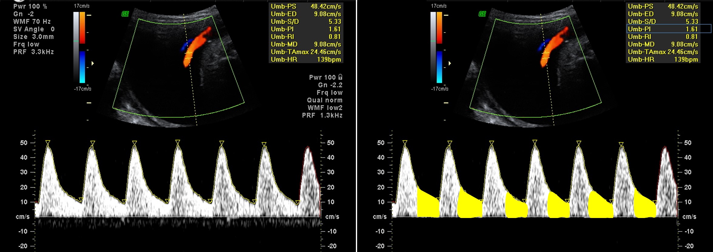 interpretacao-do-doppler-obstetrico-na-avaliacao-da-vitalidade-fetal-image-4