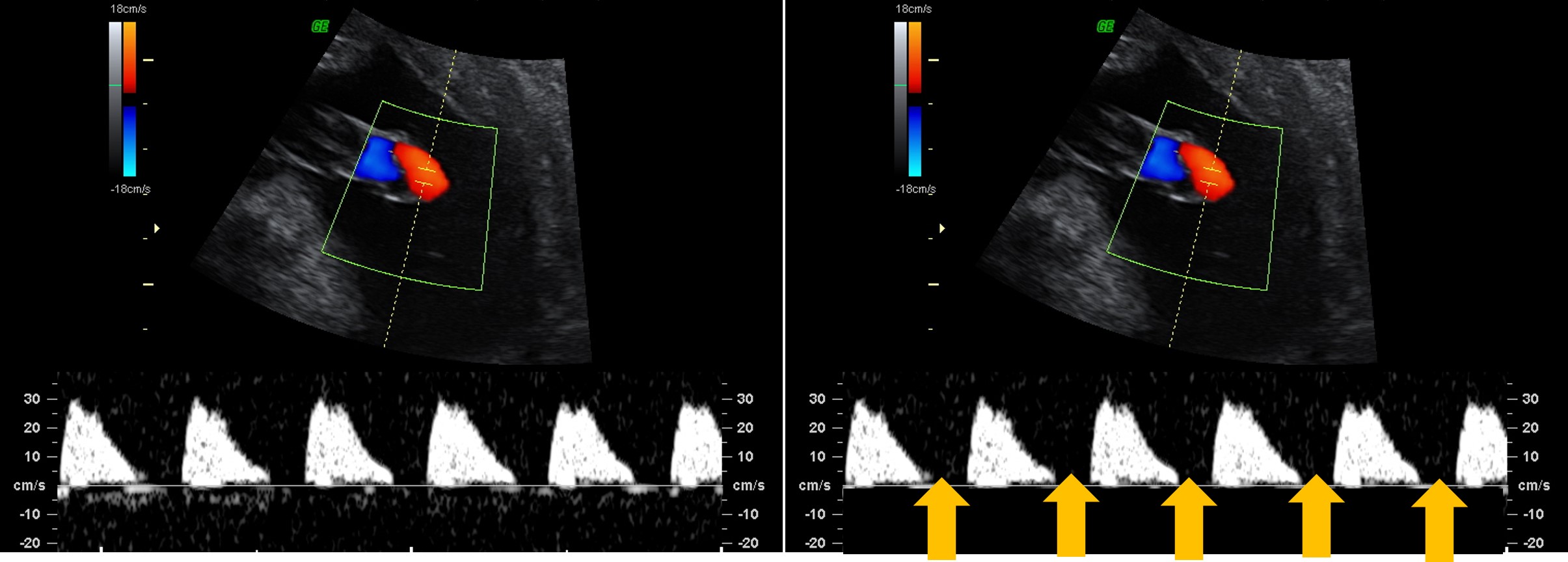 interpretacao-do-doppler-obstetrico-na-avaliacao-da-vitalidade-fetal-image-5