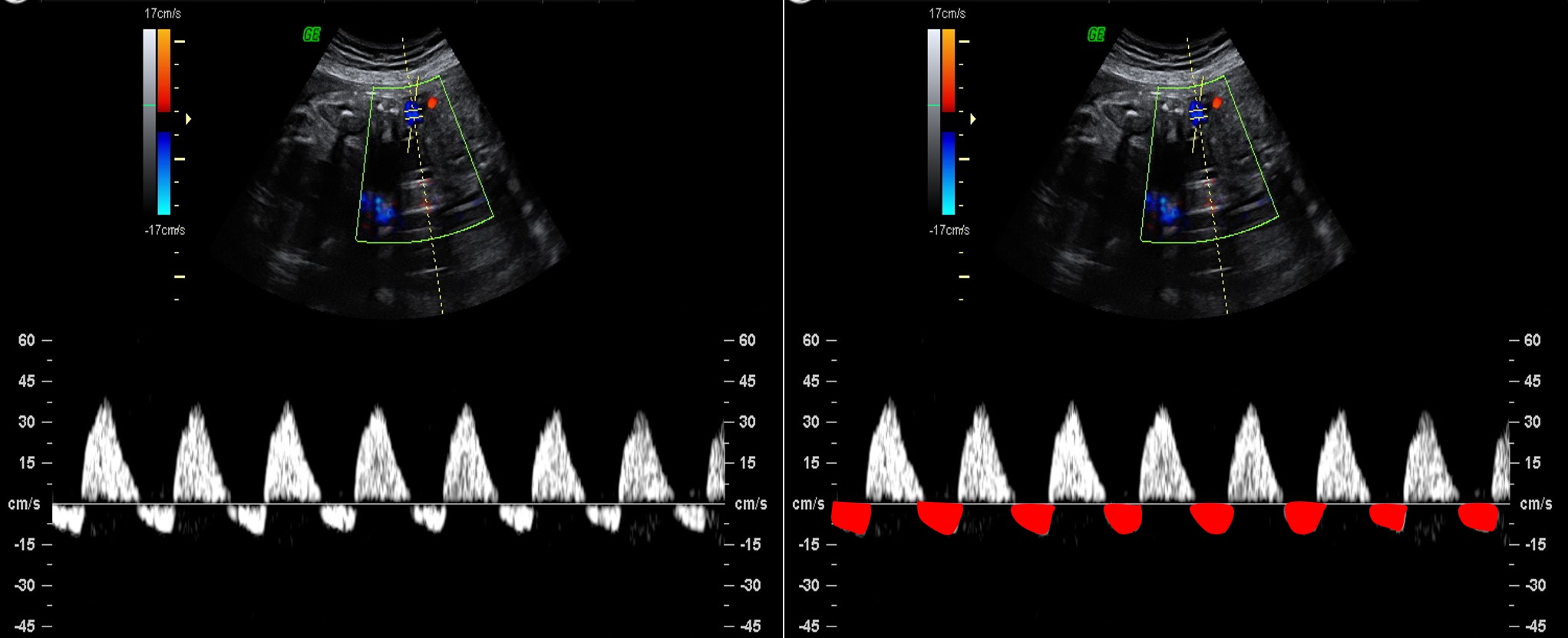 interpretacao-do-doppler-obstetrico-na-avaliacao-da-vitalidade-fetal-image-6