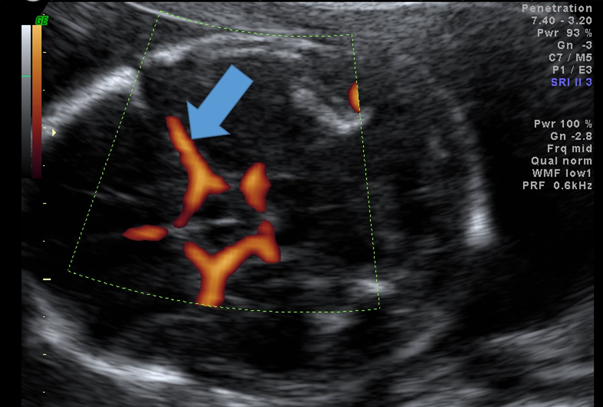 interpretacao-do-doppler-obstetrico-na-avaliacao-da-vitalidade-fetal-image-7
