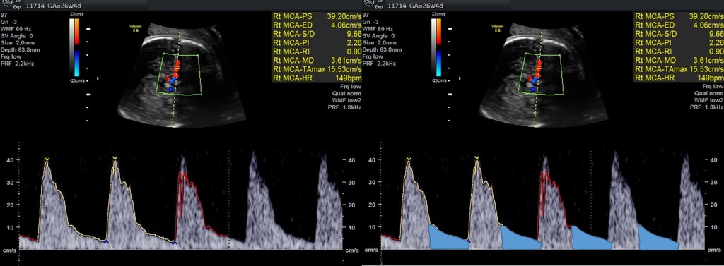 interpretacao-do-doppler-obstetrico-na-avaliacao-da-vitalidade-fetal-image-9