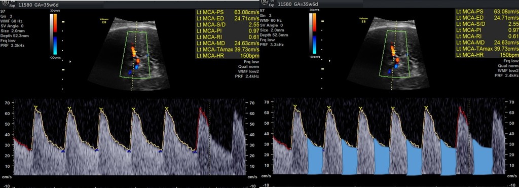 interpretacao-do-doppler-obstetrico-na-avaliacao-da-vitalidade-fetal-image-10