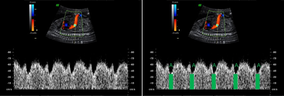 interpretacao-do-doppler-obstetrico-na-avaliacao-da-vitalidade-fetal-image-44
