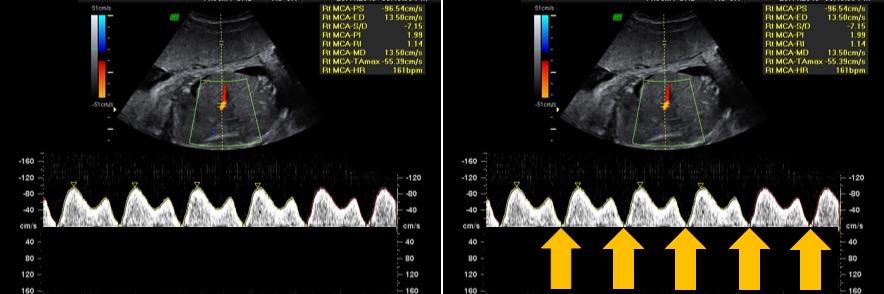 interpretacao-do-doppler-obstetrico-na-avaliacao-da-vitalidade-fetal-image-46