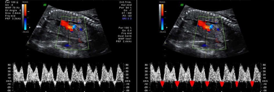 interpretacao-do-doppler-obstetrico-na-avaliacao-da-vitalidade-fetal-image-48
