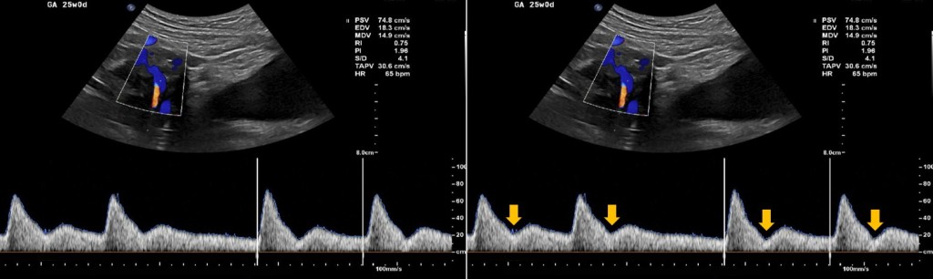 interpretacao-do-doppler-obstetrico-na-avaliacao-da-vitalidade-fetal-image-17