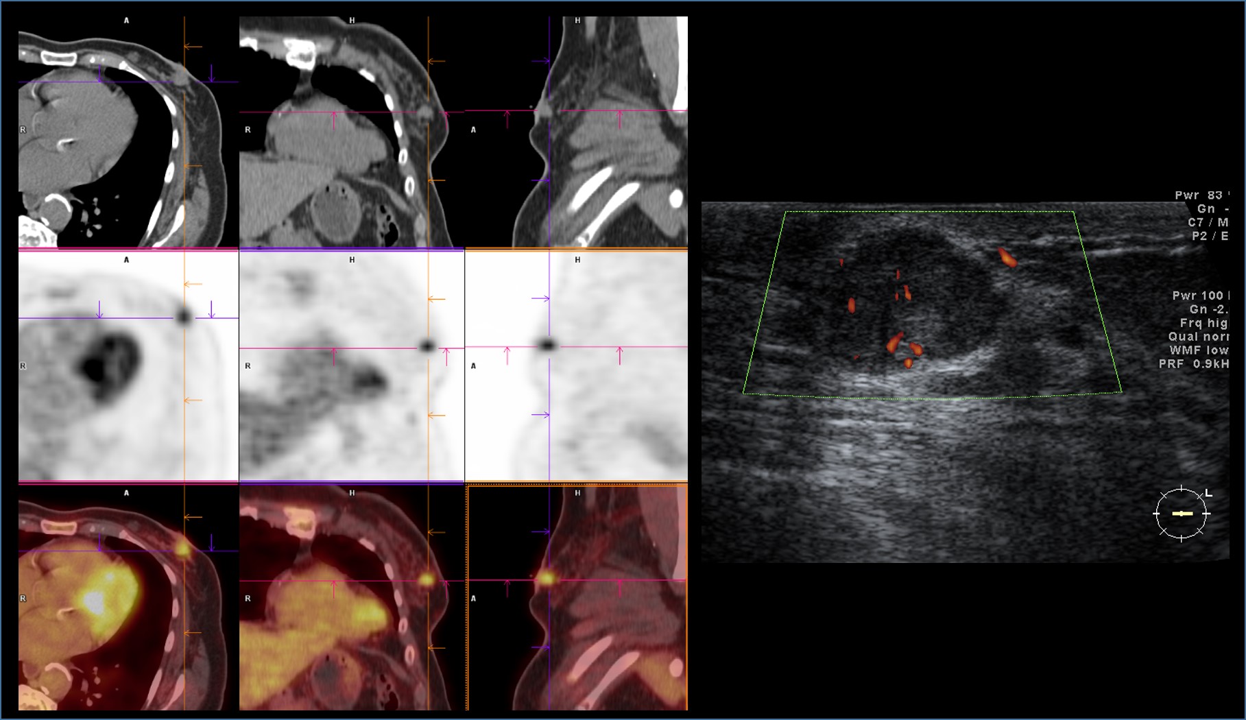 Intraductal papilloma - pet / ct and breast ultrasonography