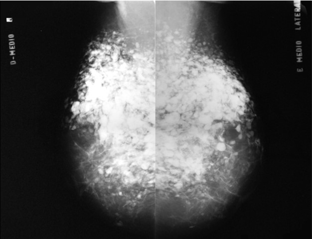 Inyección de silicona industrial intramamario - aspectos mamográficos