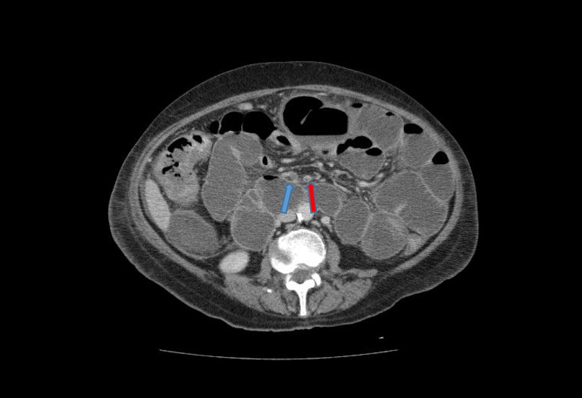 Isquemia mesentérica aguda