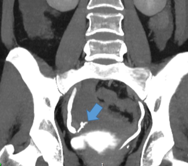 Lesão ureteral distal durante histerectomia. Achados da tomografia computadorizada.