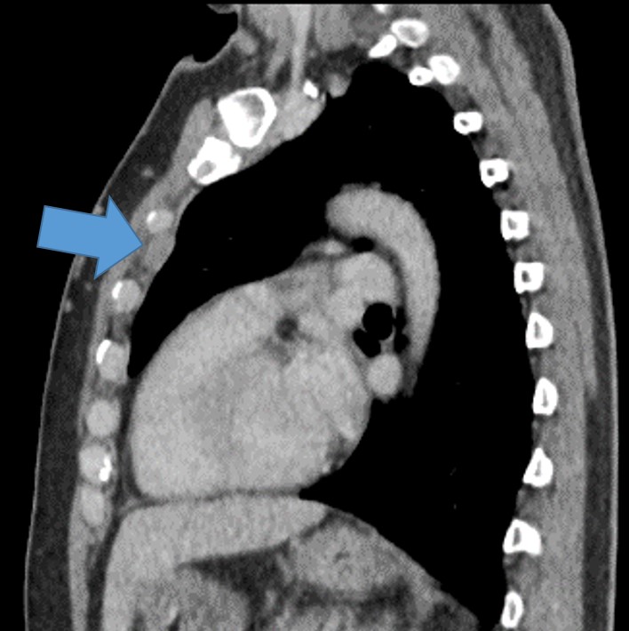 Linfonodo suspeito na cadeia mamária interna em paciente com câncer de mama