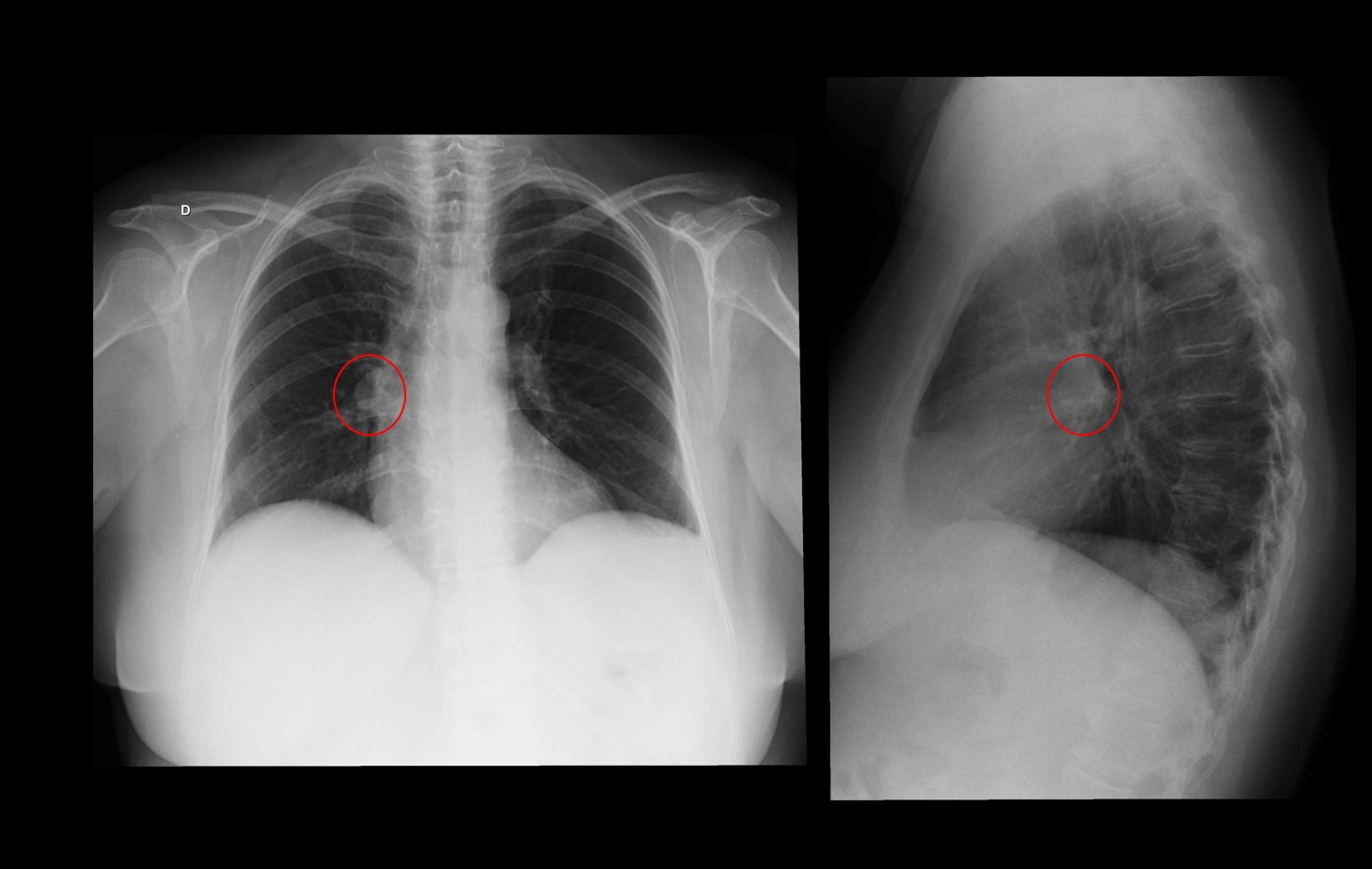Linfonodomegalia mediastinal