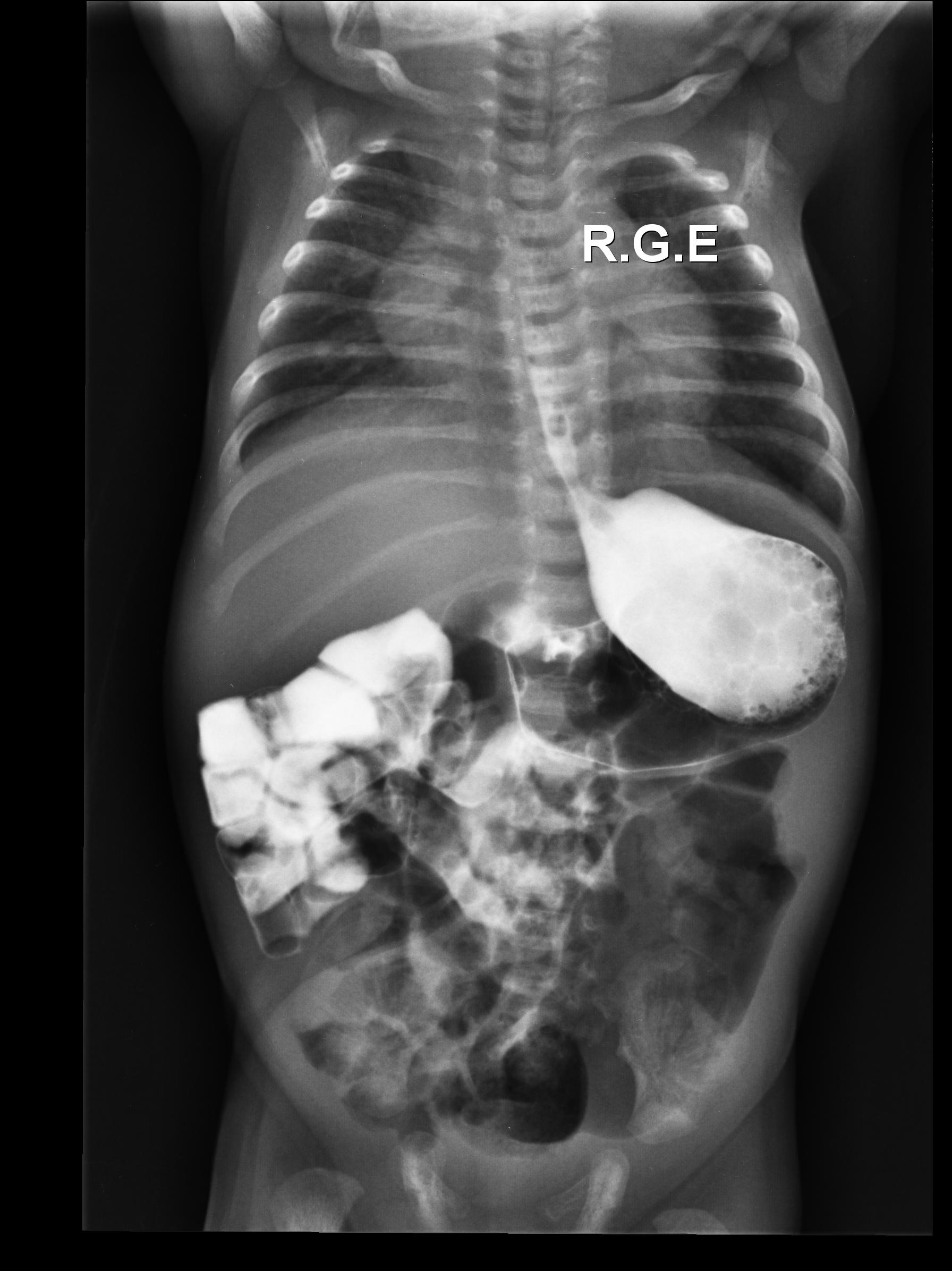 Má-rotação Intestinal
