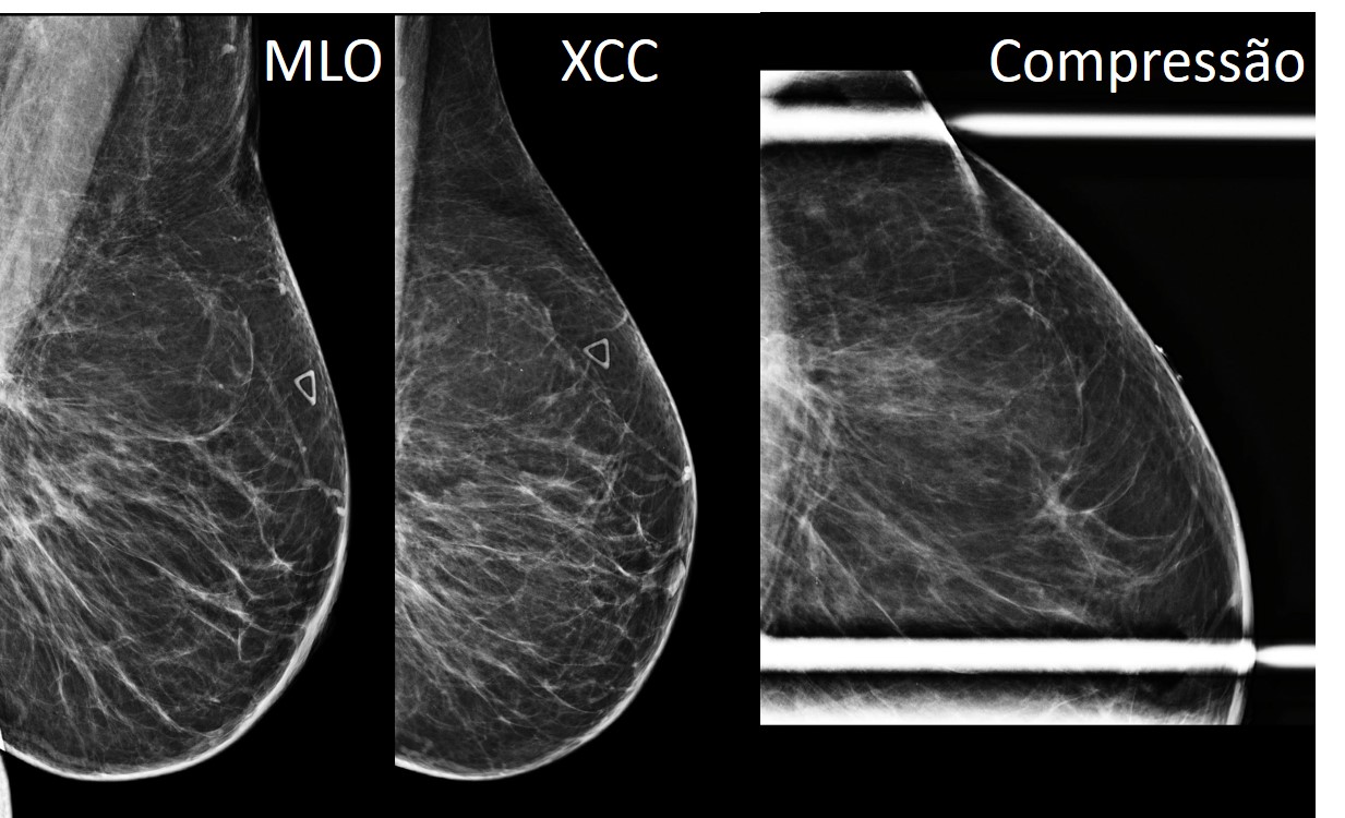Mammographic and ultrasound findings of a palpable lipoma