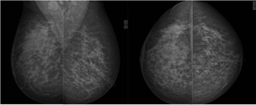 Mamografia - assimetrias