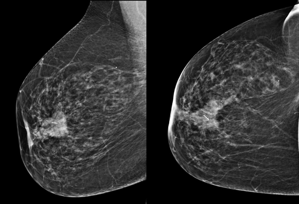 Mamografia com nódulo com diagnóstico de câncer de mama clipado pré quimioterapia neoadjuvante.