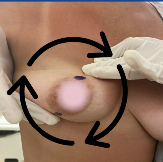 Manobra de rolagem na mamografia