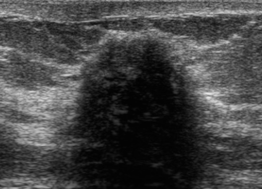 Mastopatia diabética