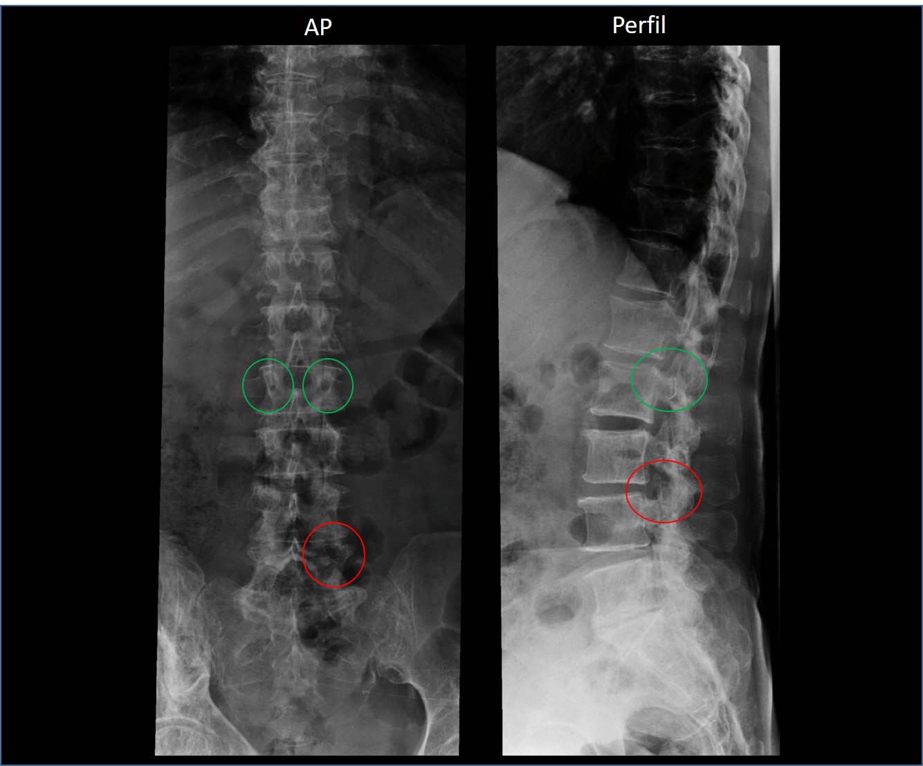 Metástase de câncer de mama para pedículo vertebral