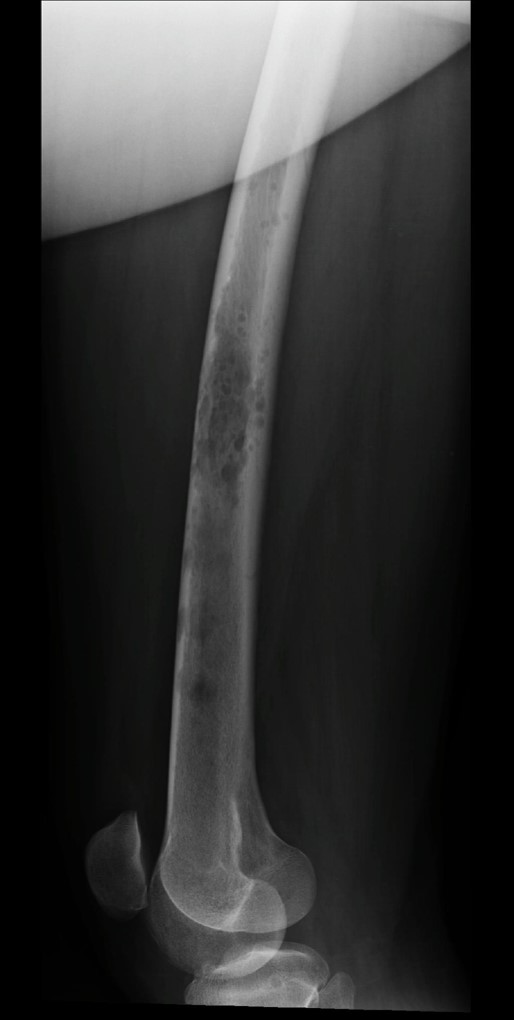 Metástases ósseas osteolíticas - câncer de mama