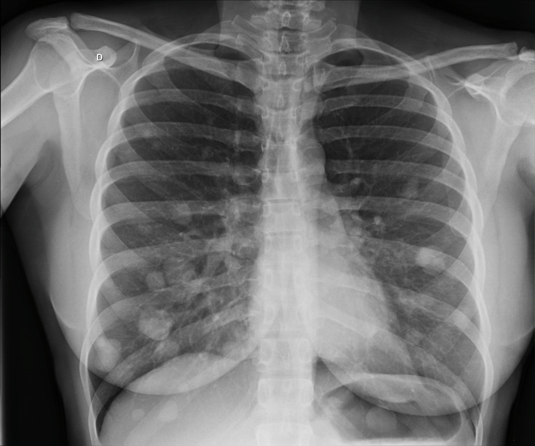 Metástases pulmonares de neoplasia trofoblástica gestacional