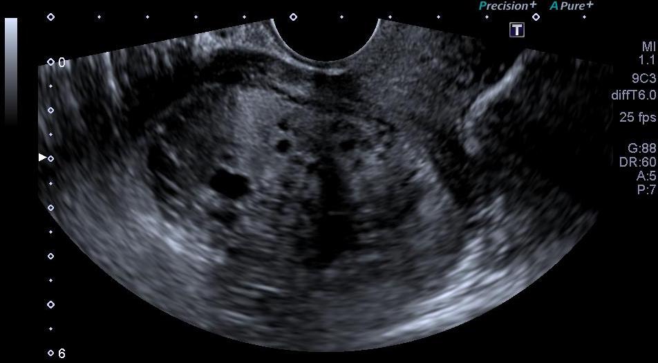 Mola Hidatiforme Completa