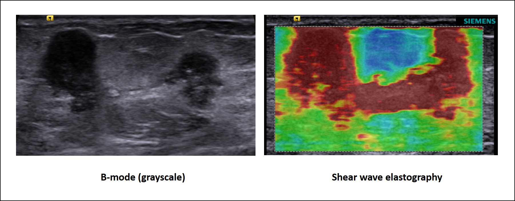 Multifocal breast cancer elastography