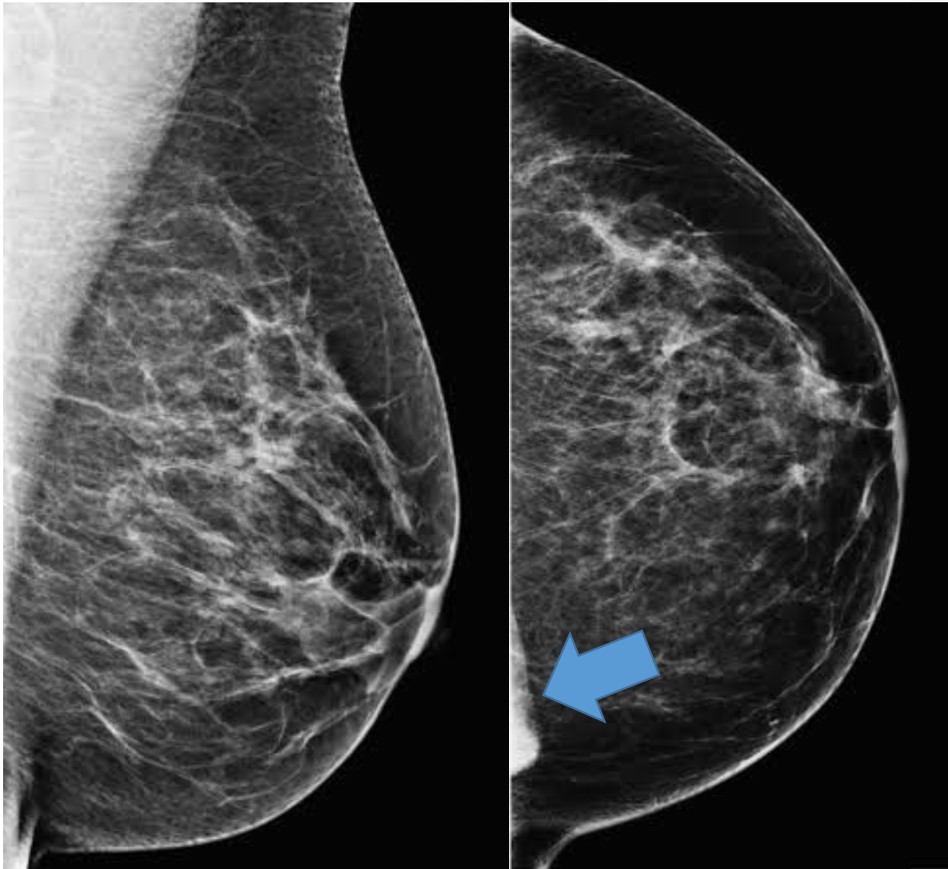 Músculo esternal simulando assimetria na mamografia