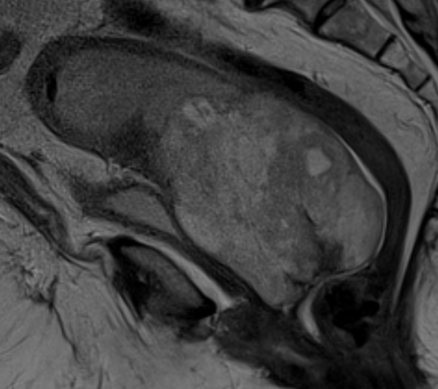 Neoplasia fusocelular uterina. Achados da ressonância magnética.