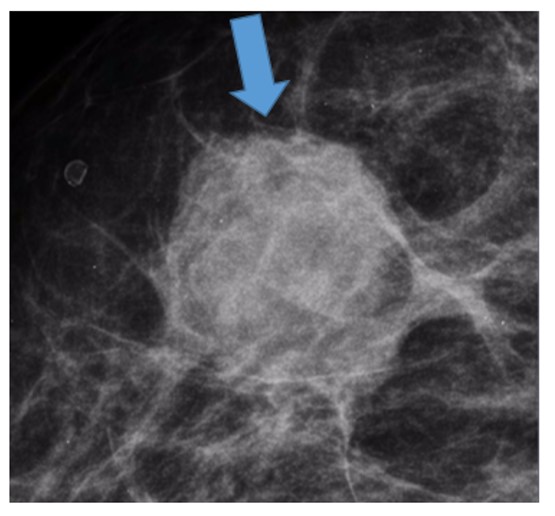 Nódulos na mamografia - descrição e classificação segundo o bi-rads