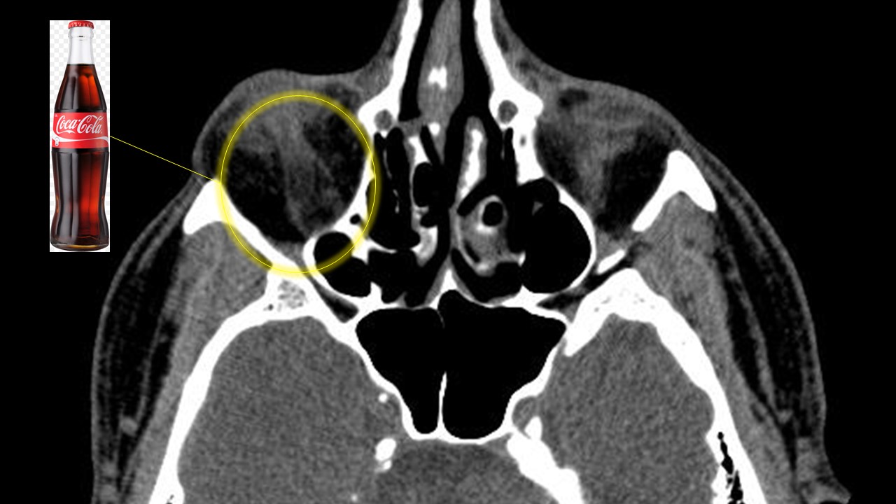 Oftalmopatia Tireoidea (Oftalmopatia de Graves)