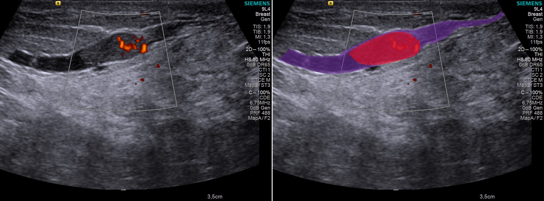 Papiloma intraductal