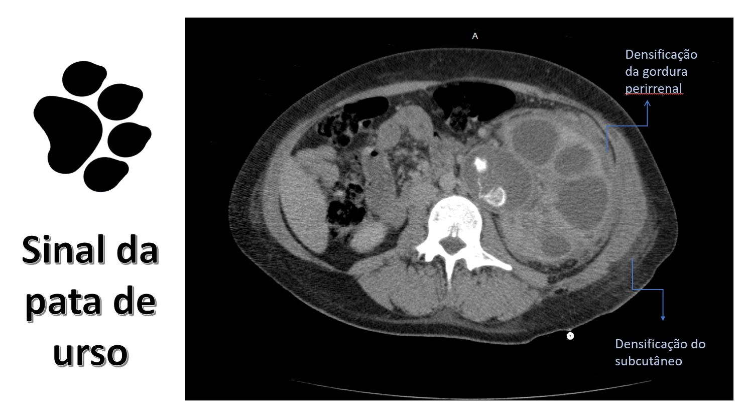 Pielonefrite xantogranulomatosa