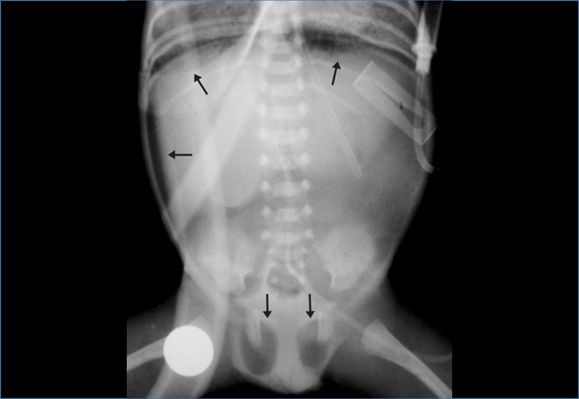Pneumotórax, enfisema pulmonar intersticial e pneumoperitôneo em recém-nascido sob ventilação mecânica: aspectos radiológicos