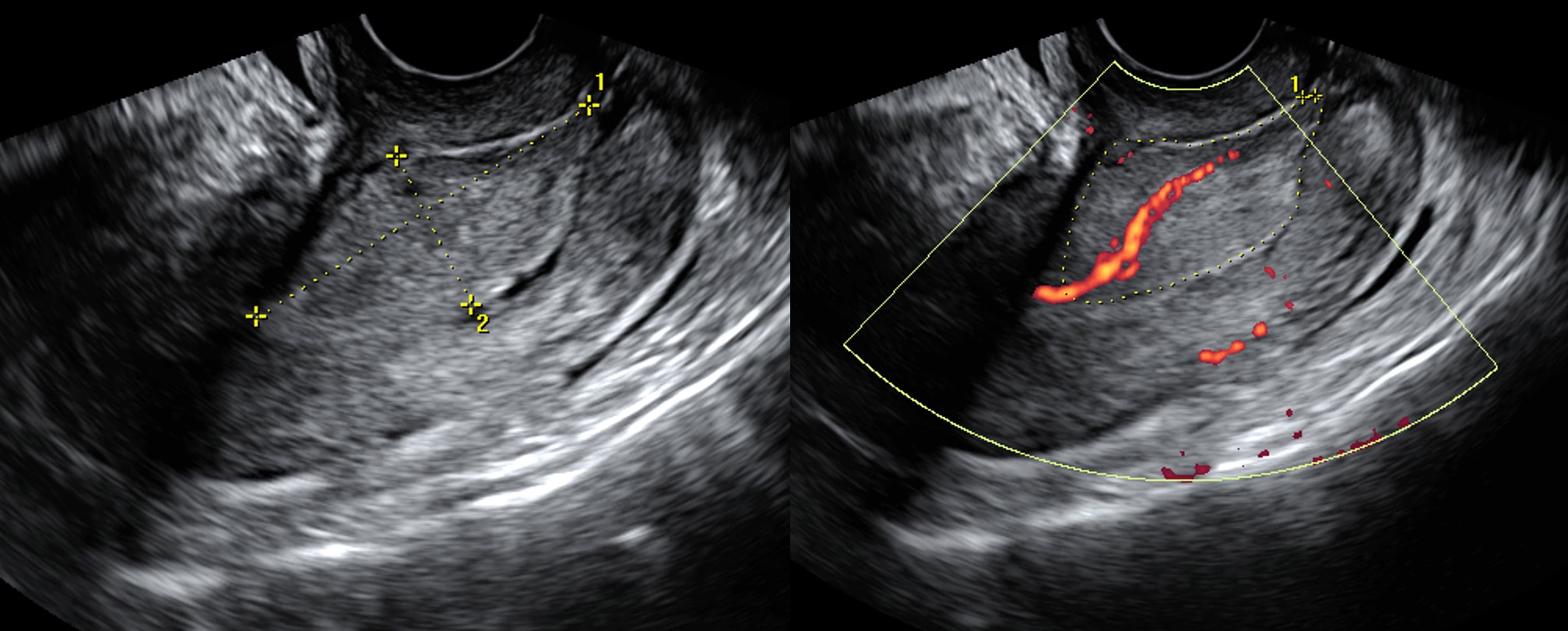 Pólipo endometrial no canal cervical