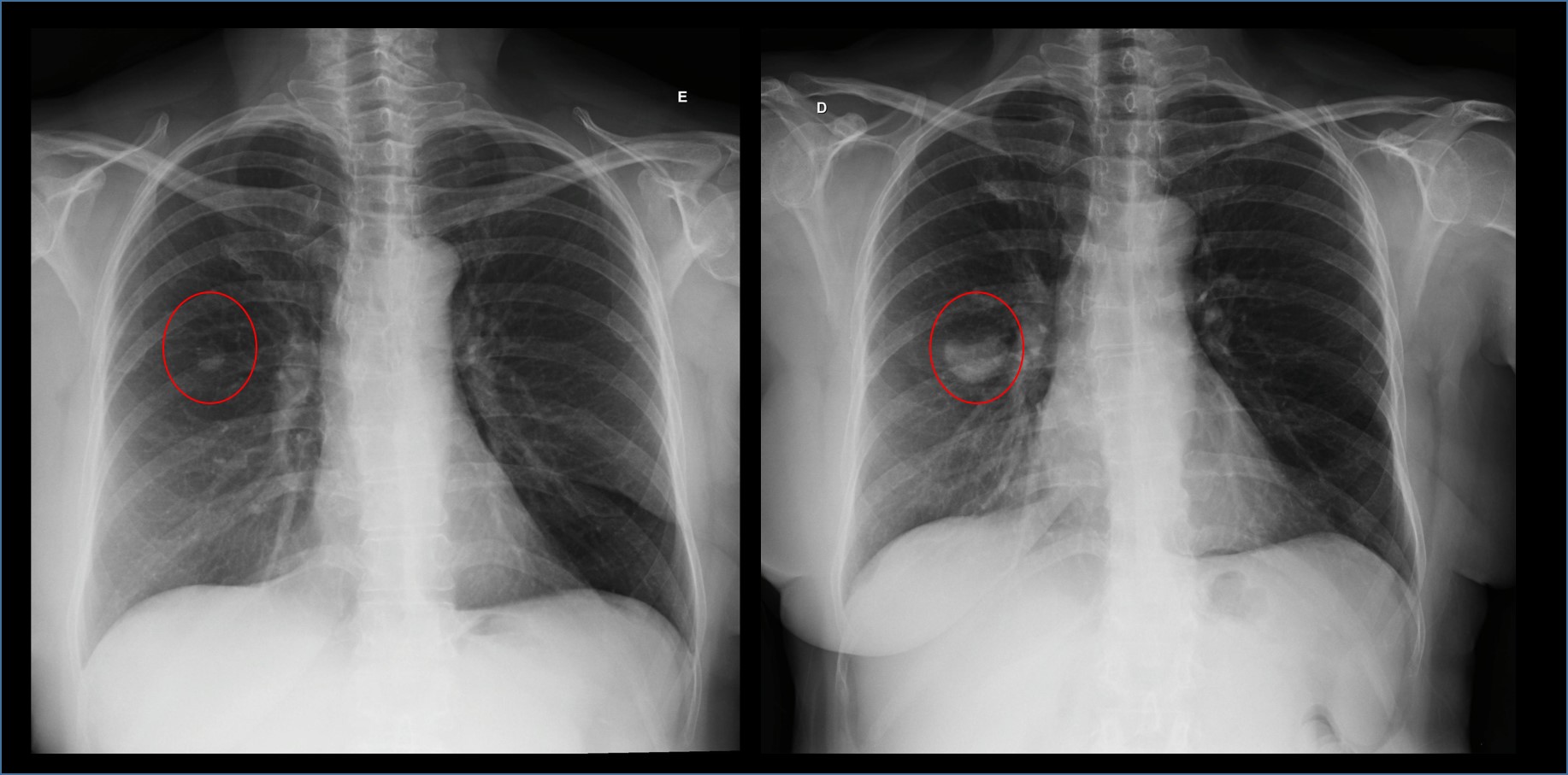 Progressão de metástase pulmonar