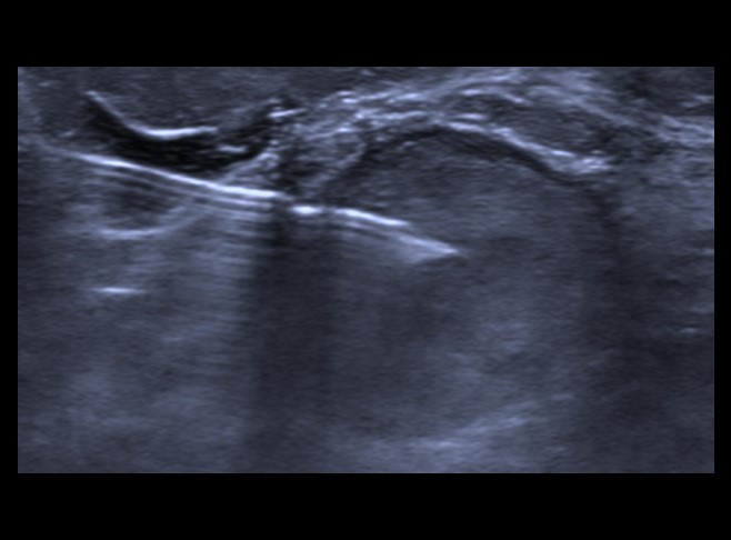 Punção aspirativa por agulha fina de galactocele