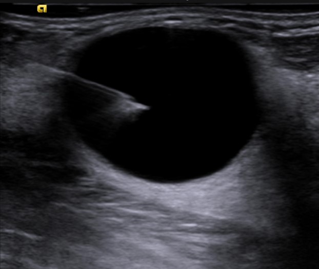 Punção aspirativa por agulha fina (PAAF) de cisto simples mamário