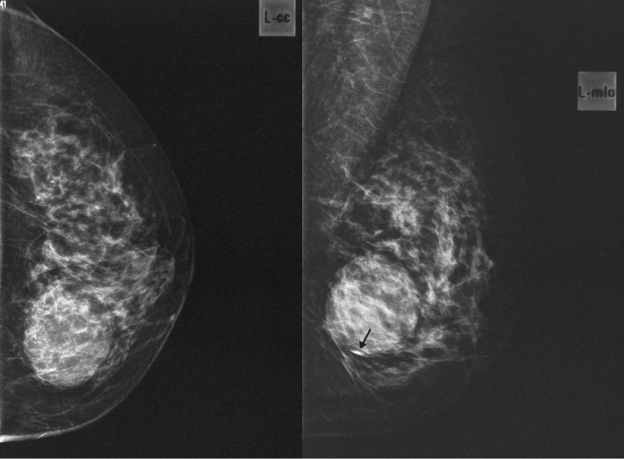 Quiste de mama con leche de calcio- hallazgos mamográficos