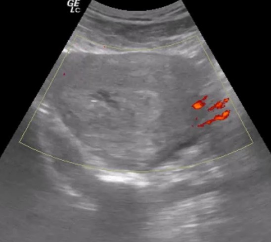 Retenção placentária por acretismo.