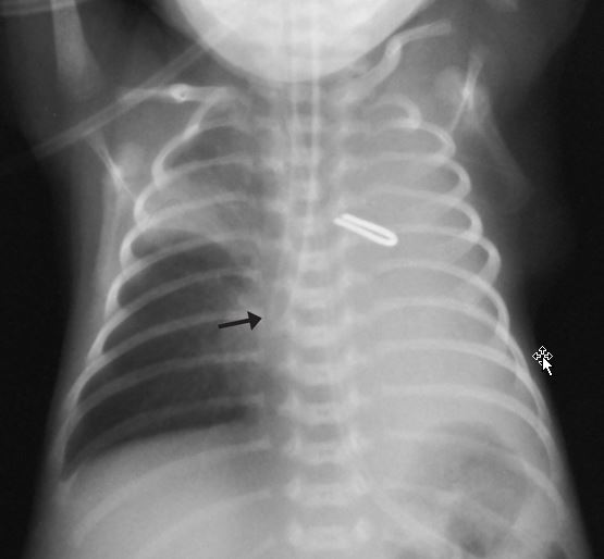 Selective intubation in a premature infant