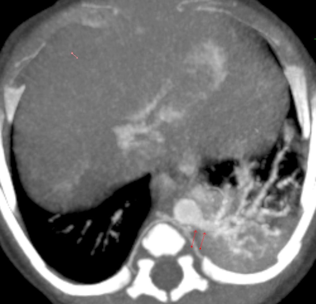 Sequestro pulmonar intralobar