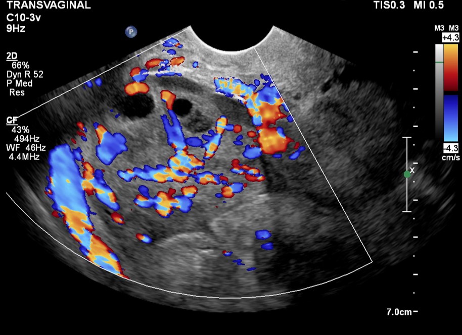 Sinais de ooforite pela ultrassonografia